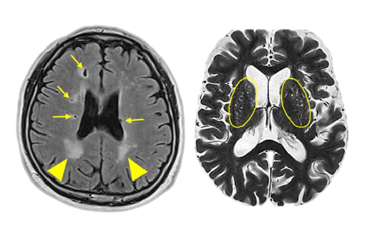 뇌백질 고신호 병변(좌측 사진 화살촉), 열공성 뇌경색(좌측 사진 화살표), 확장성 혈관주위 공간(우측 사진 양쪽 타원 안쪽의 하얀 점들)이 나타난 뇌 MRI 사진