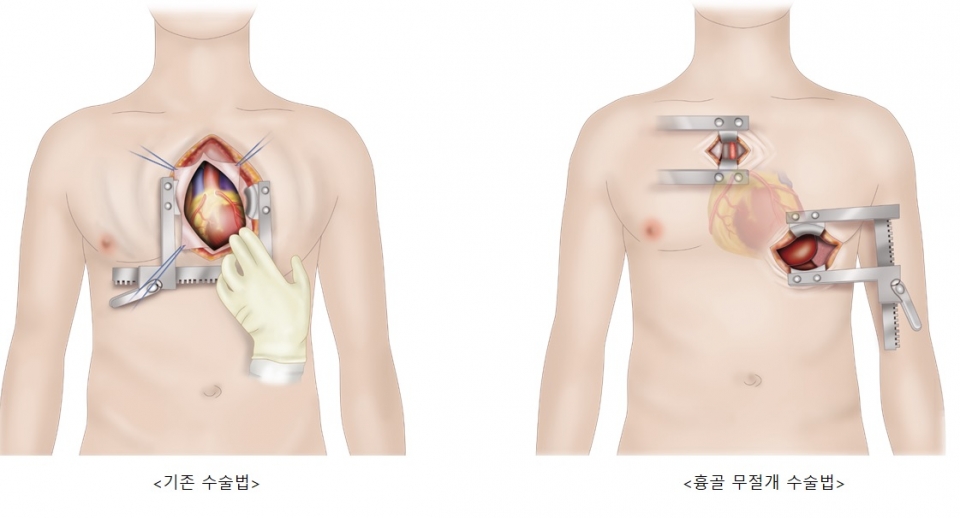 인공심장 이식 수술시 기존 방법과 흉골 무절제 수술법과의 비교. (자료=삼성서울병원)