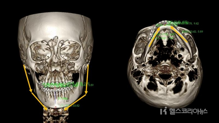 3D CT를 이용하여 환자데이터를 정밀분석한 모습.