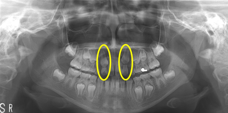 [사진1] 상악 좌·우측 견치의 이소맹출(치아가 비정상적인 위치로 맹출하는 것)이 관찰되며(노란색 원), 인접한 치아의 뿌리를 흡수시키고 있다.