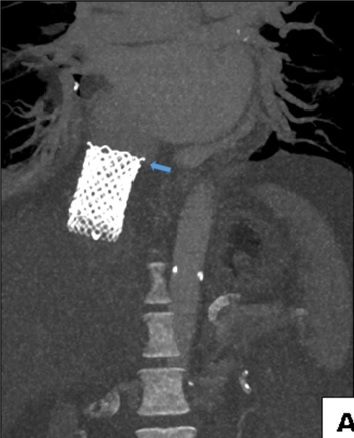 시술 3일 후 촬영한 CT 영상. 판막은 삽입된 위치 그대로 우심방 입구부터 하대정맥에 걸쳐 있다.