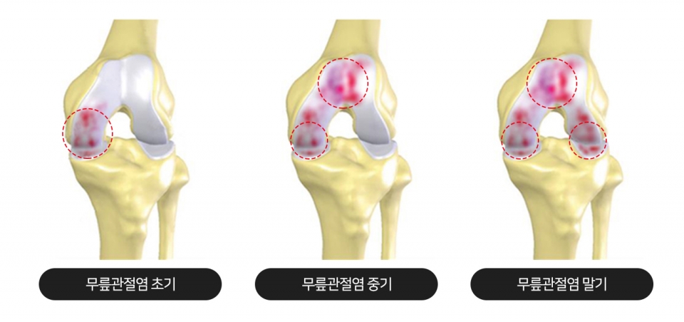 무릎관절염 진행단계