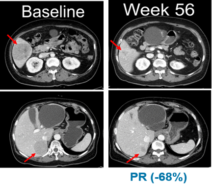 임상 시작 전(Baseline, 왼쪽)과 ‘벨바라페닙’ 투여 56주 후 흑색종 환자의 복부 CT 사진