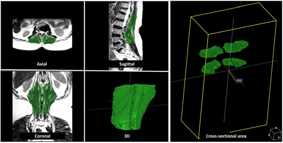 척추 MRI에서 요추 주위근의 3D분할 화면.