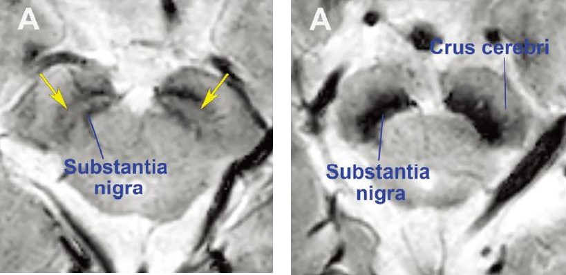 정상 모양의 흑질(좌), 파킨슨병 환자의 흑질(우) MRI 영상