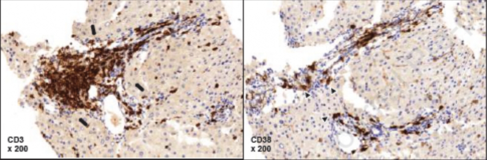 CD3+ T세포가 주된 침윤(왼쪽 가운데 검은색 화살표)과 형질세포를 나타내는 CD38+ 세포(오른쪽)의 침윤 확인