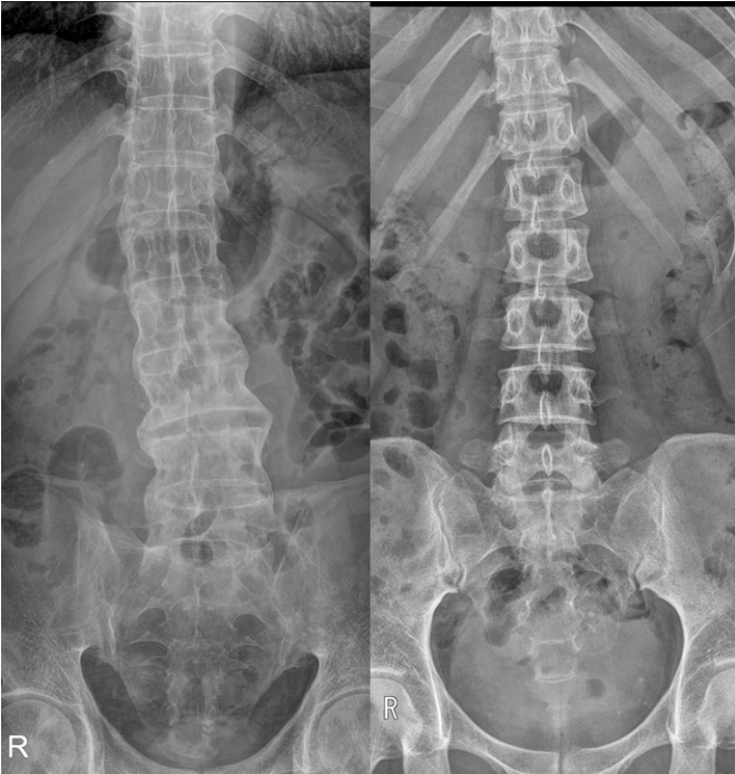 강직성척추염(왼쪽)은 정상 척추(오른쪽)와 비교해 관절 없이 하나의 긴 뼈처럼 이어진 모습을 보여 ‘대나무 척추(bamboo spine)’로도 불린다.