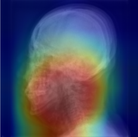 [두경부 X-ray 영상을 활용한 수면무호흡증 진단 예시]딥러닝 알고리즘이 수면무호흡증 여부를 분류하는 이미지 상 특이점의 위치(붉은색)를 확인할 수 있다.