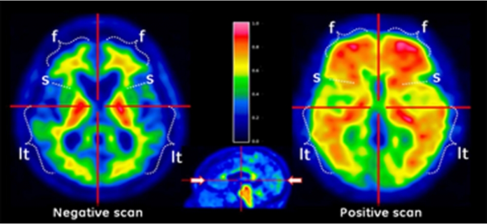 방사성의약품 '비자밀'로 베타 아밀로이드 분포를 컬러 영상으로 나타낸 모습. (좌)Negative scan(음성 스캔), (우)Positive scan(양성 스캔)으로 푸른색과 초록색은 베타 아밀로이드 밀도가 낮음을, 주황색 붉은색은 밀도가 높음을 의미한다.