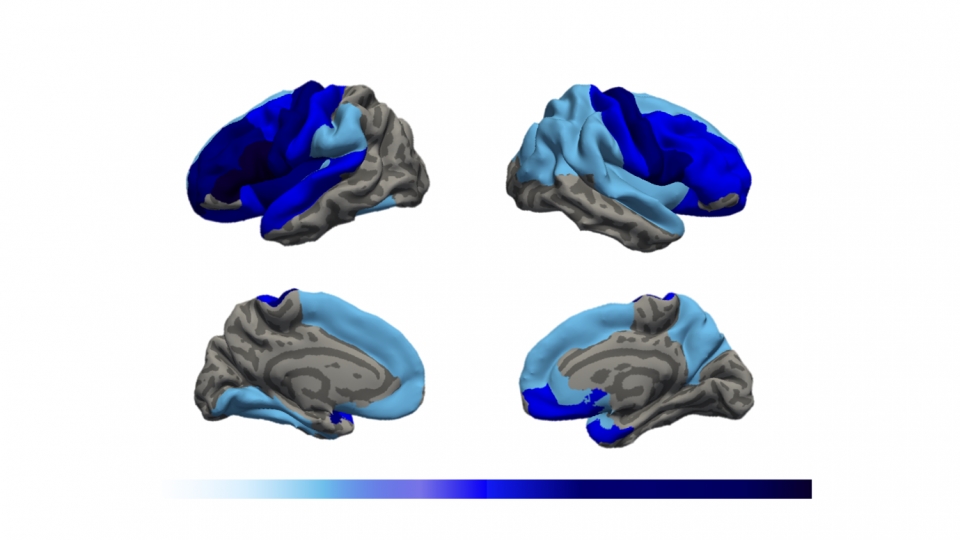 (위) 대뇌의 바깥쪽, (아래) 대뇌의 안쪽. 짙은 파란색일수록 뇌 주름의 정도가 감소되어 있음을 의미.