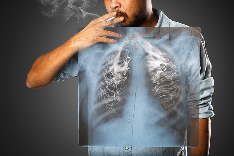 흡연을 하는 사람의 폐는 이렇습니다.&nbsp;