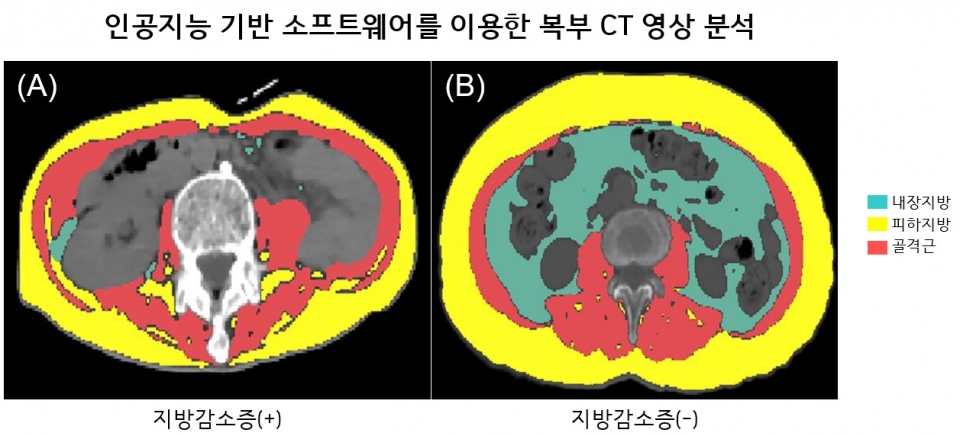 인공지능 기반 소프트웨어로 체성분 분석한 루게릭병 환자의 복부 CT영상. 지방감소증 동반한 환자 (A)는 CT검사 1개월째 사망한 반면, 지방감소증 동반하지 않은 환자 (B)는 35개월(관찰기간) 동안 생존함.
