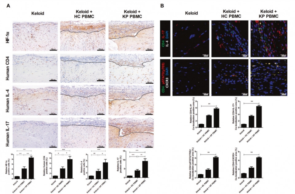 PDKK 모델의 이식된 조직의 신생 조직 생성 확인과 신생 조직에서의 염증성 IL-17 사이토카인 발현과 HIF-1α 발현 확인