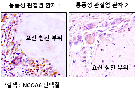 통풍성 관절염 환자의 병변부위에 핵수용체 활성보조인자 6(Nuclear receptor coactivator, NCOA6)의 발현이 증가되어 있음