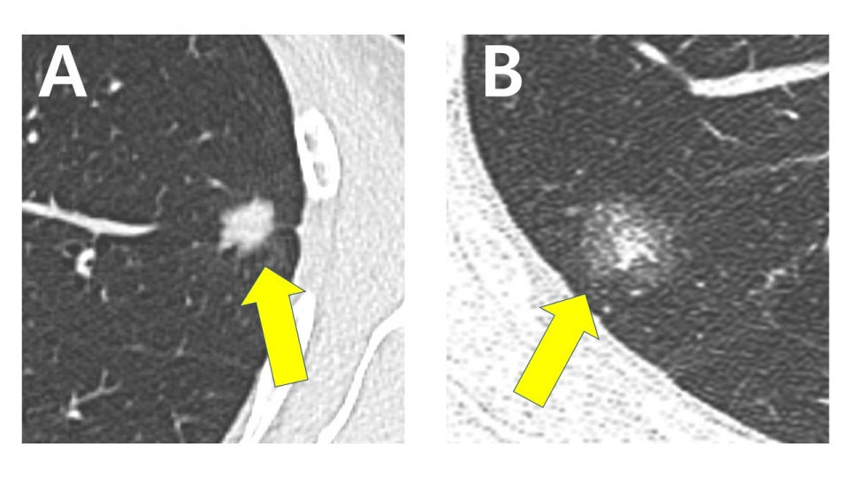 (A)순수 고형(pure solid)으로 보이는 종양, (B)간유리 음영(ground glass opacity)을 포함한 종양의 CT 이미지