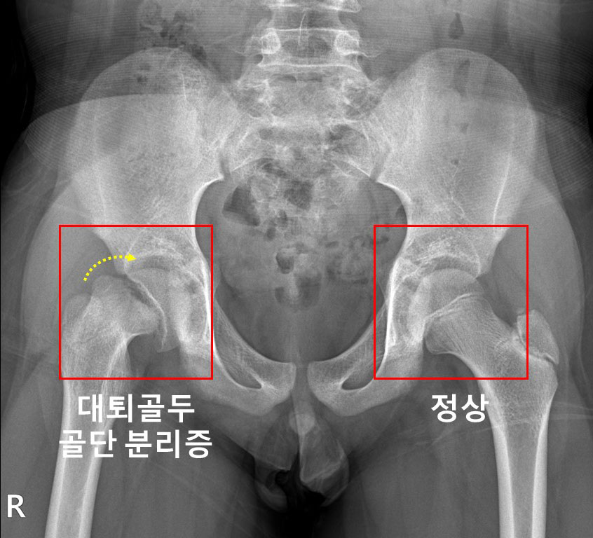 우측 고관절에 대퇴골두 골단 분리증이 발생한 소아청소년 환자의 X-ray