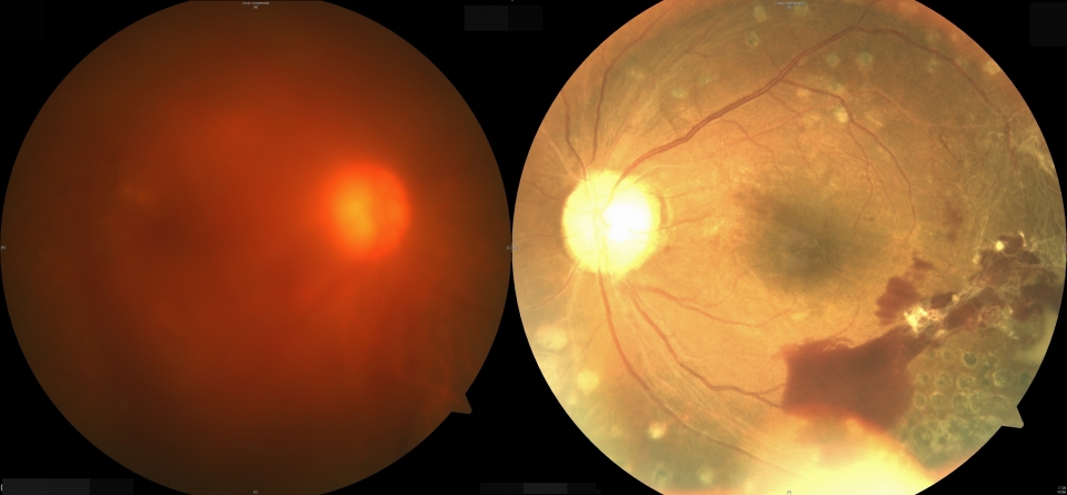 증식성 당뇨병성망막병증 환자의 망막, 유리체 출혈(왼쪽)과 망막 앞 출혈(오른쪽)