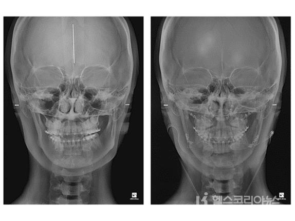 안면비대칭 방사선 사진. 수술 전(왼쪽)과 후(오른쪽) 비교.