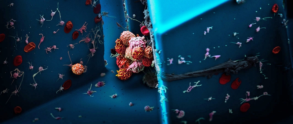 바젤대 연구팀이 유방암 환자의 혈액에서 격리된 혈중 순환종양세포군을 스캔 전자 현미경으로 촬영한 뒤 이미지화 한 영상 (사진=스위스 바젤대 니콜라 아케토 교수)