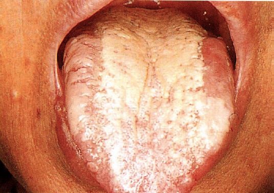 구강작열감 증상을 나타내는 구강 캔디다증(진균감염) 환자의 사진 설태 설암 혀암 입속바이러스