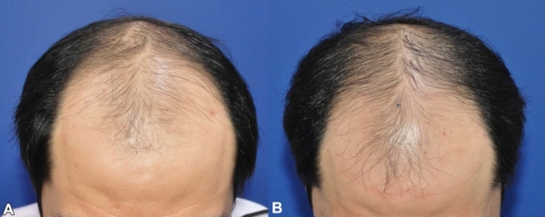脱毛部位に対するナボタ注射前（左）と注射後（右）の写真。(ヘルスコリアニュース / http://www.hkn24.com)