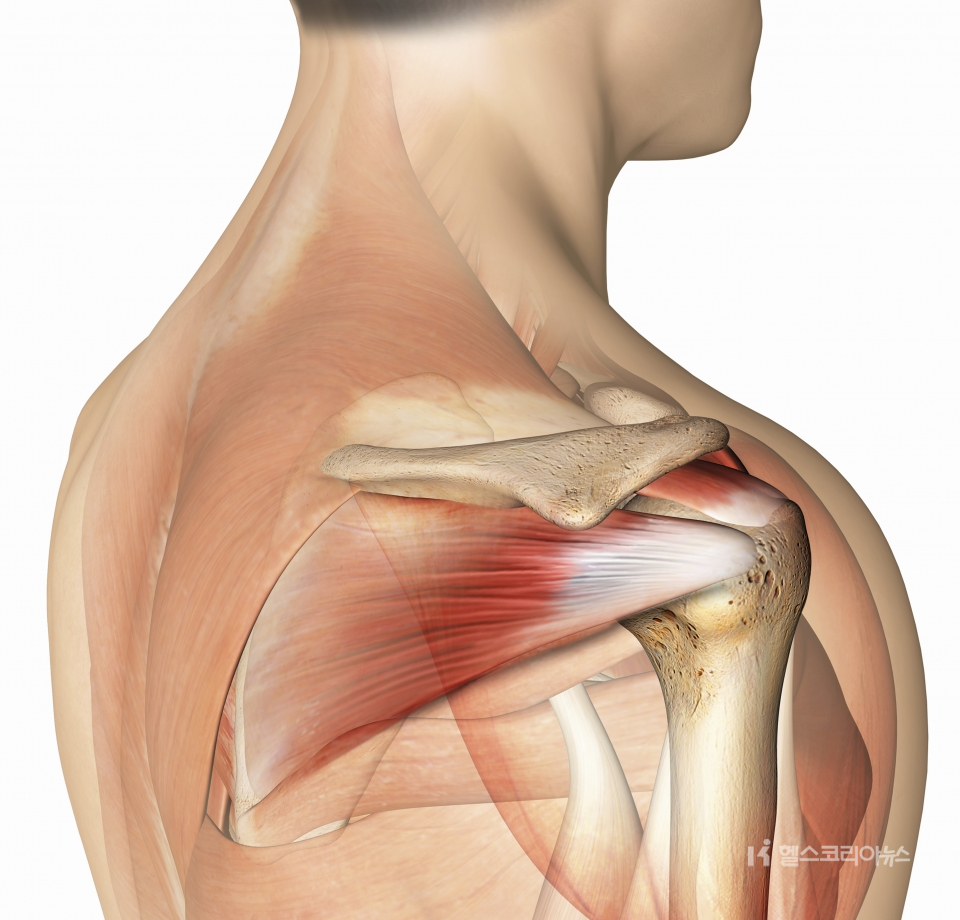 회전근개파열 어깨충돌증후군 견봉 어깨힘줄 어깨부상