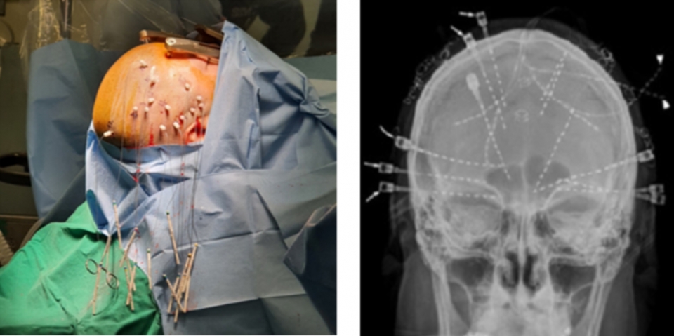 뇌안에 14개의 심부전극이 삽입된 모습(왼쪽)과 여러개의 심부전극이 뇌안에 들어있는 X-ray 사진.