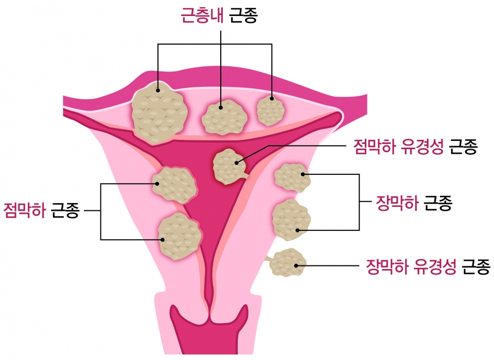 부위별 자궁근종의 종류 및 증상