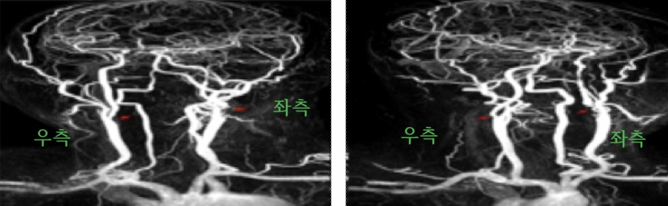 양측 내경동맥 협착이 있는 환자의 조영증강 자기공명혈관조영 사진으로 붉은 화살표가 협착 부위를 나타낸다. 사진은 실제와 좌-우가 반대로 보인다. 우측보다 좌측 내경동맥의 협착이 더 심한 것이 확인된다.