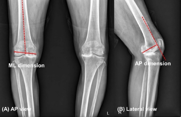 퇴행성 관절염 무릎의 수술 전 X-ray에서 대퇴골 모양 파악을 위한 가로 및 세로 길이 측정, 대퇴골의 가로길이 측정법(왼쪽), 대퇴골의 세로 길이 측정법(오른쪽) [사진=강북삼성병원 제공]