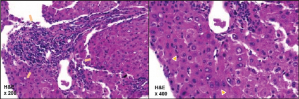 H&E염색 시 간문맥 중증도 염증 및 조각 괴사와 계면간염 확인(왼쪽)/ 간 세포 주위 다른 세포가 부착하여 장미꽃 모양처럼 보이는 로제트형성 확인(오른쪽)