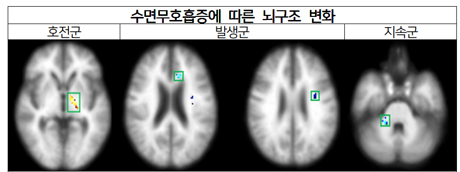 수면무호흡증에 따른 뇌구조 변화.호전군에서는 시각기억 경로의 회복(노란색)을 확인했으며, 발생군과 지속군에서는 시각기억 관련된 부위의 뇌손상(파란색을) 확인할 수 있다. [사진=분당서울대병원 제공]