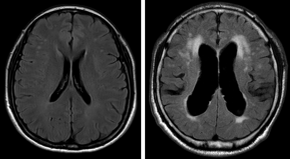 <strong>정상 뇌(좌)와 정상압 수두증 환자의 뇌(우) MRI 비교</strong><br><br>​​​​​​​정상 뇌에 비해 오른쪽 정상압 수두증 환자에서는 과다 축적된 뇌척수액으로 인해 뇌실이 확장되어 있는 것을 확인할 수 있다.