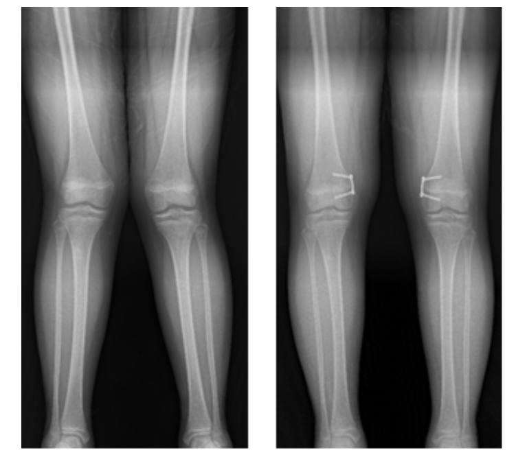 외반슬(엑스자 다리)에 대해 8자 금속판을 이용한 대퇴골 내측 반성장판 유합술 후 교정된 환자(좌- 교정 전, 우-교정 후)