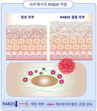 RAB25가 결핍되면 세포 운동성이 떨어져 케라토하이알린과립 성장이 저해되는 것으로 확인됐다. [사진=연세의료원 제공]