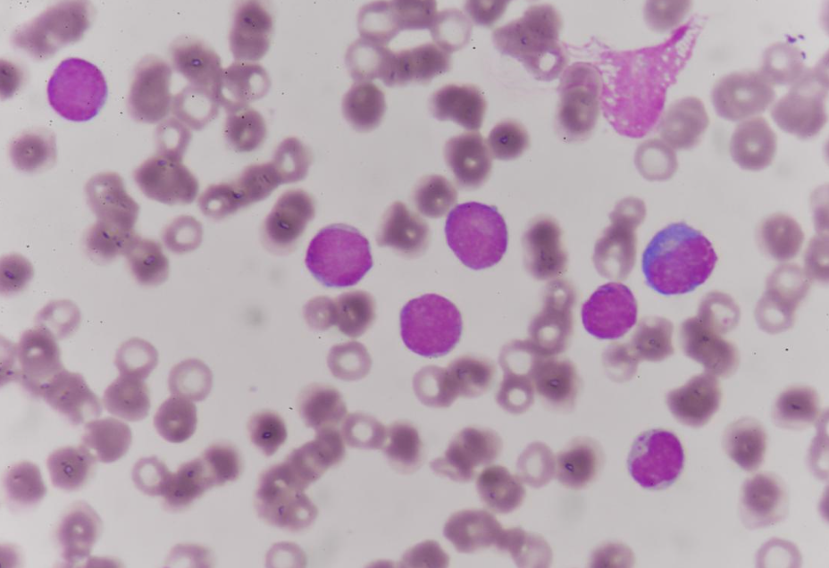 급성골수성백혈병(acute myeloid leukemia, AML) 암세포 현미경 사진