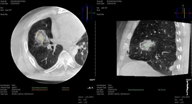 대장암 폐 전이 고주파 열 치료 시술 직후 Cone Beam CT 소견.