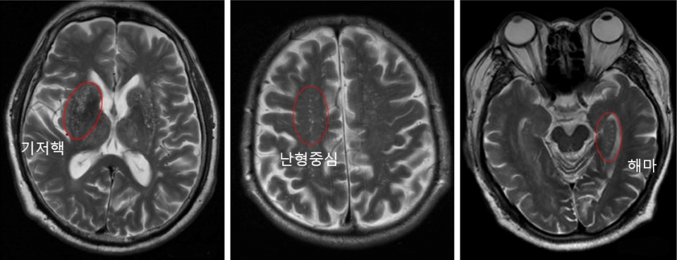 저핵, 난형중심, 해마 부위 뇌혈관 주위 공간 확장이 심한 환자의 뇌 MRI 영상 [사진=상계백병원 제공]