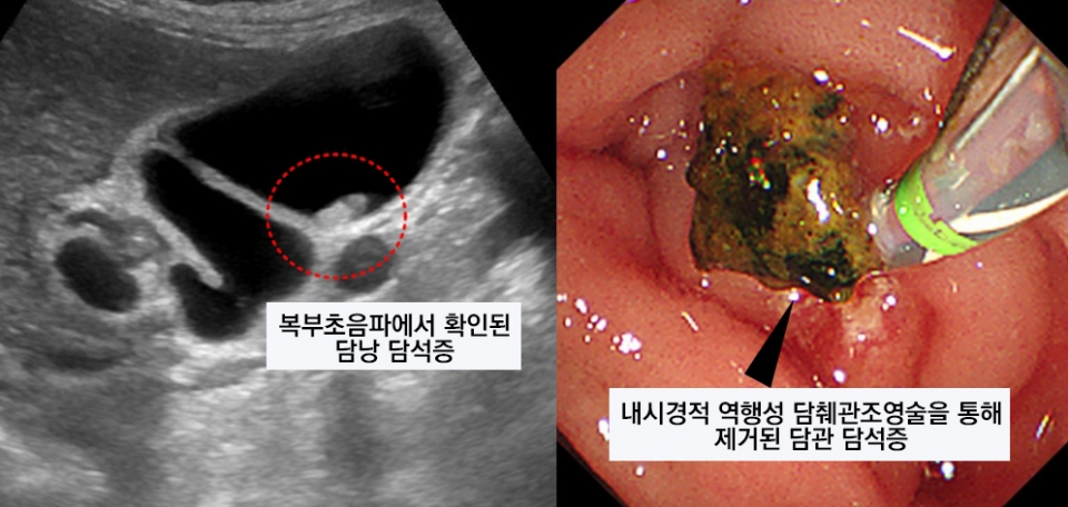 사진은 복부초음파(왼쪽) 모습과 내시경적 역행성 담췌관조영술(ERCP)를 통해 확인된 담석증(오른쪽) 모습.