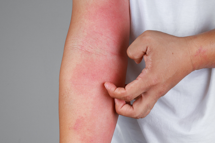 <br>피부질환은 종류가 많다. 건선, 땀띠, 뾰루지, 여드름, 아토피, 알레르기, 비립종 등 대부분 피부염증과 관련돼 있고 질환에 따라 가려움증도 유발한다.<br><br> 