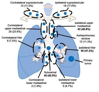 폐 SBRT 후 국소 림프샘 재발 부위.국소 림프샘 재발 부위를 평가한 결과 일반적인 부위는 동측 폐문(47.2%), 동측 상부 종격동(40.6%) 및 하부 흉곽하(42.5%)였다.