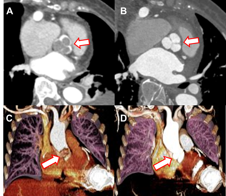 [그림 A, C] CT에서 대동맥 판막 바로 위 부분에 큰 혈전이 관찰된다.[그림 B, D] LVAD 기기 조정 및 항응고제 치료 후 추적 관찰 CT에서 혈전이 소멸되었다.