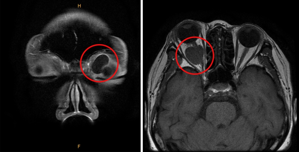 좌측 안와 앞쪽에 생긴 낭성 종괴(왼쪽)와 우측 안와 뒤쪽에 생긴 시신경종양(오른쪽)