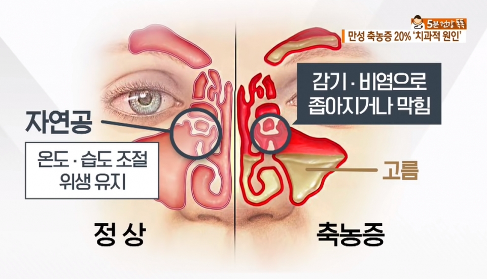 부비동염(축농증) [KBS방송화면 캡처]